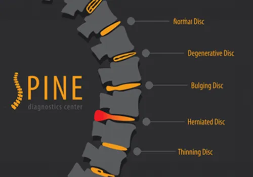 Chiropractic Jacksonville FL Herniated Disc